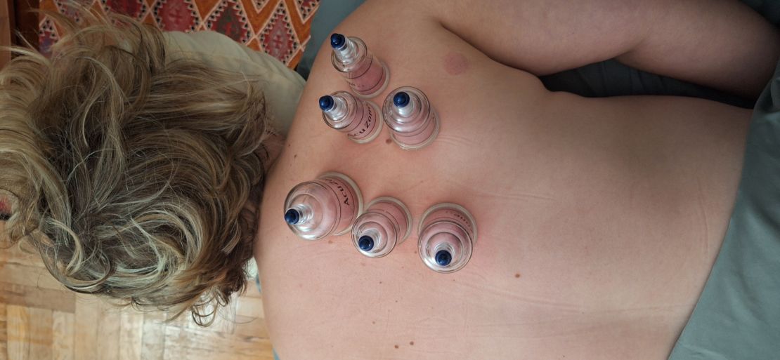 Cupping